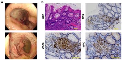 Case Report: A Case of Intestinal Behçet's Disease Exhibiting Enhanced Expression of IL-6 and Forkhead Box P3 mRNA After Treatment With Infliximab